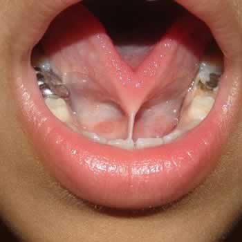 Tongue Tied Treatment Cork