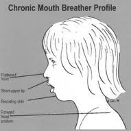 Mouth Breather Symptoms