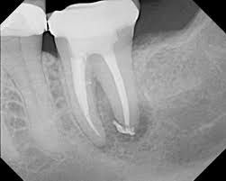 Root Canal Treatment Ballincollig