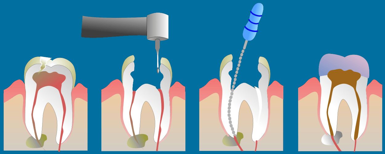 Root Canal Treatment Cork