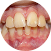 Crooked Teeth Treatment